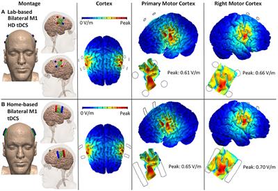 The Concept, Development, and Application of a Home-Based High-Definition tDCS for Bilateral Motor Cortex Modulation in Migraine and Pain
